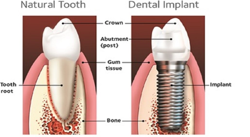 Dental Implants Queensland Country Health Fund   Dental Implant 